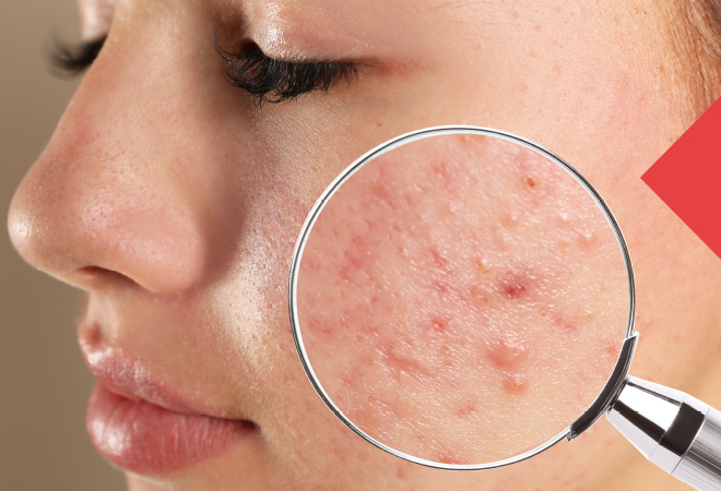 información sobre ele acné